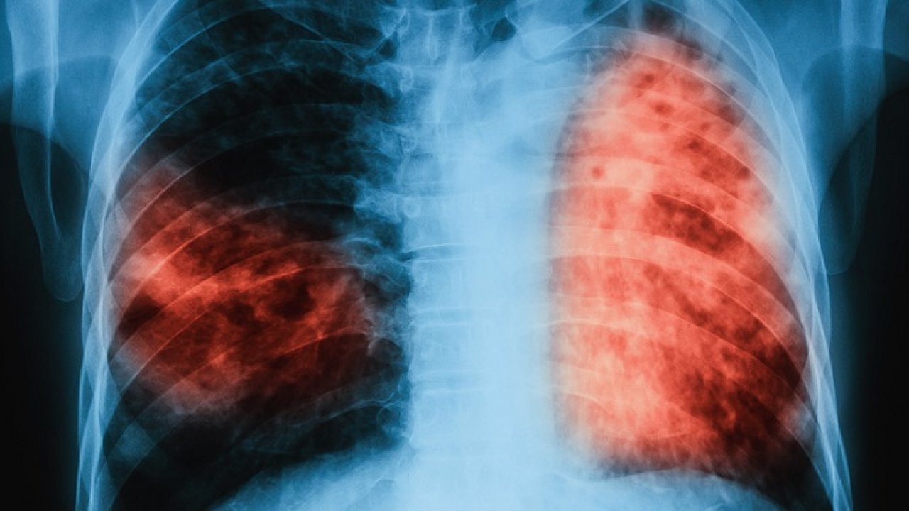 Превенција кључна у борби против туберкулозе и плућних болести